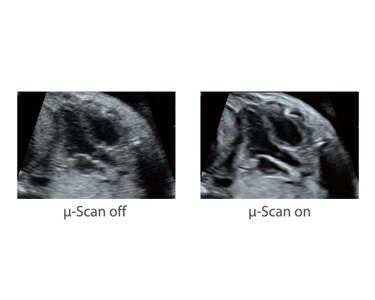 SonoScape - P15 Trolley Color Doppler Ultrasound System