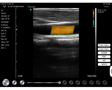 Linear Ultrasound Probes with iPhone/iPad App
