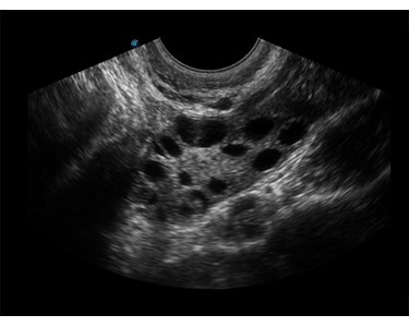 SonoScape - E3 Portable Color Doppler Ultrasound System