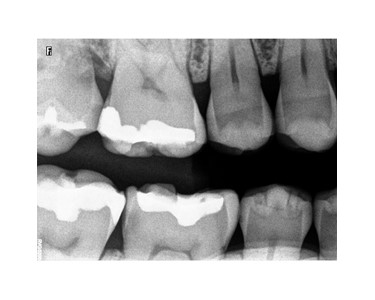 Carestream Dental - Intraoral Sensor | RVG 5200 System