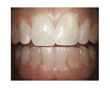 Carestream Dental - Intraoral Camera | CS 1500