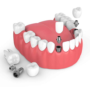Dental Implant