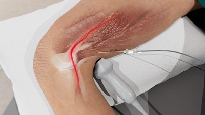 How to Perform an IPACK Block with Ultrasound