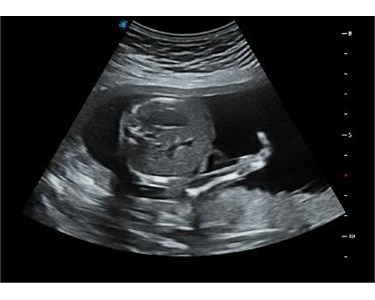 SonoScape - P20 Trolley Color Doppler Ultrasound System