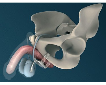 ATOMS Moderate & Severe SUI