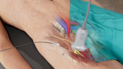 How to Perform a Femoral Block