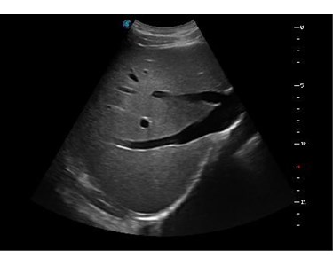 SonoScape - P20 Trolley Color Doppler Ultrasound System