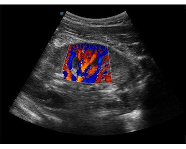 SonoScape - E3 Portable Color Doppler Ultrasound System