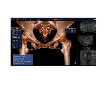Sectra - 3D Imaging System | 3D Joint Replacement