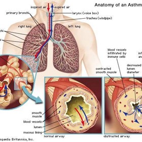 Mystery of How Eating Causes Asthma Attacks
