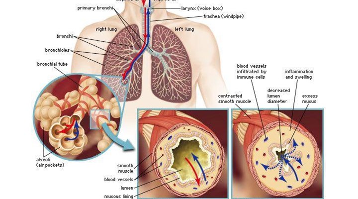 Anatomy of an Asthma Attack