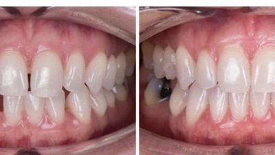 Mild Class III - Anterior Crossbite, Spacing (SureSmile Aligners)