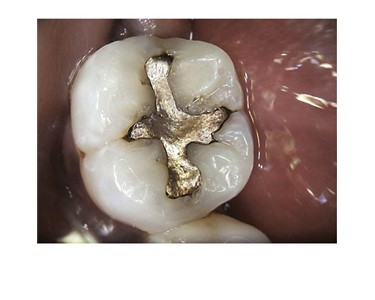 Carestream Dental - Intraoral Camera | CS 1500