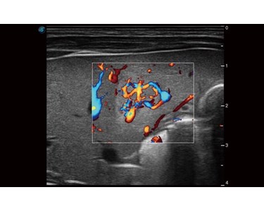 SonoScape - P40 Elite Trolley Color Doppler Ultrasound System