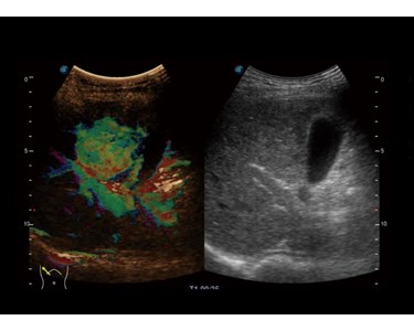 SonoScape - P60 Trolley Color Doppler Ultrasound System