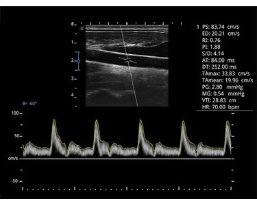 SonoScape - E1 B/W Portable Ultrasound