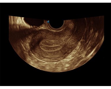 SonoScape - S8 Exp Portable Color Doppler Ultrasound Scanner