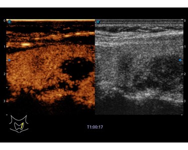 SonoScape - P60 Trolley Color Doppler Ultrasound System