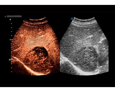 SonoScape - P50 Trolley Color Doppler Ultrasound System