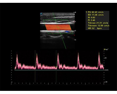 SonoScape - S8 Exp Portable Color Doppler Ultrasound Scanner