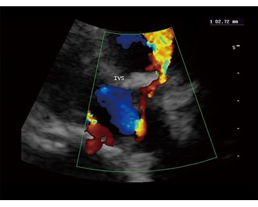 SonoScape - S9 Portable Color Doppler Ultrasound System