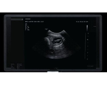 Crystal-Clear Image Samsung V8 Ultrasound