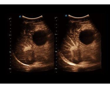 SonoScape - P60 Trolley Color Doppler Ultrasound System