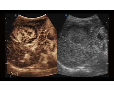 SonoScape - P40 Elite Trolley Color Doppler Ultrasound System