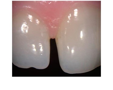 Carestream Dental - Intraoral Camera | CS 1200 