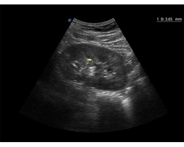 SonoScape - E1 B/W Portable Ultrasound