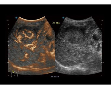 SonoScape - P60 Trolley Color Doppler Ultrasound System