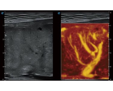 SonoScape - P40 Elite Trolley Color Doppler Ultrasound System