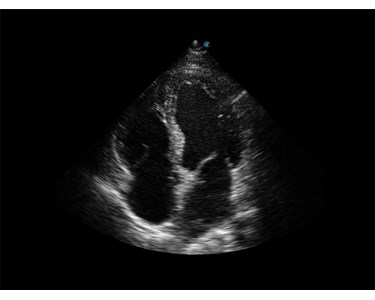 SonoScape - X3 Portable Color Doppler Ultrasound System