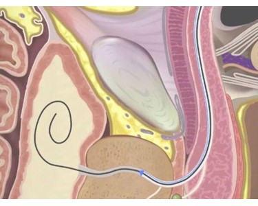 Urethral Catheterisation Device (UCD)