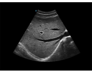SonoScape - X3 Portable Color Doppler Ultrasound System