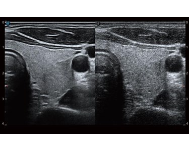 SonoScape - P40 Elite Trolley Color Doppler Ultrasound System