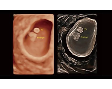 SonoScape - P40 Elite Trolley Color Doppler Ultrasound System