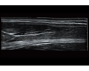 SonoScape - P15 Trolley Color Doppler Ultrasound System