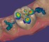 ExoCad - Chairside CAD software