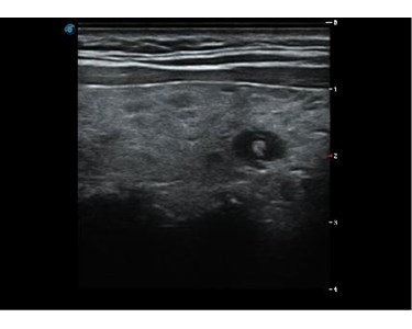 SonoScape - P20 Trolley Color Doppler Ultrasound System