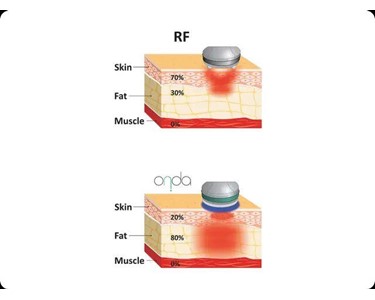 Deka - Non-Surgical Face and Body Contouring | Onda PRO