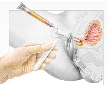 Macroplastique Mild SUI (Stress Urinary Incontinence)