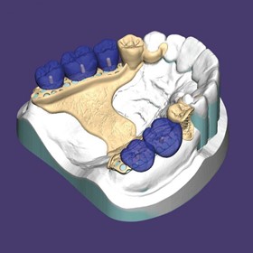 Dental Imaging Software | Stand Alone Partial CAD Module