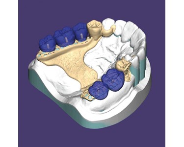 ExoCad - Dental Imaging Software | Stand Alone Partial CAD Module
