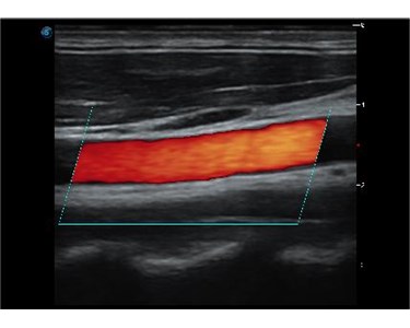 SonoScape - P20 Trolley Color Doppler Ultrasound System