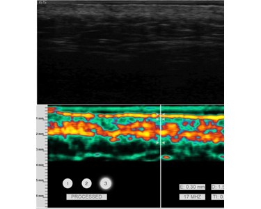 UltraVision - UltraVision™ RF Microneedling with AI Ultrasound