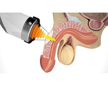 Storz Medical - Shockwave Therapy Machine | Duolith SD1 F-SW Ultra