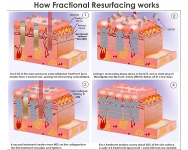 ZA CO2 Fractional Laser - CO2 Fractional Laser ZA-900S