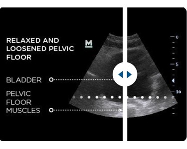 BTL - EMSELLA Incontinence Treatment  | Intimate Wellness Device