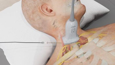 How to Perform an Interscalene Block